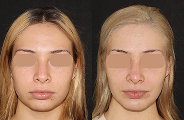 Rhinoplasty Before & After Gallery - Patient 334472 - Image 4