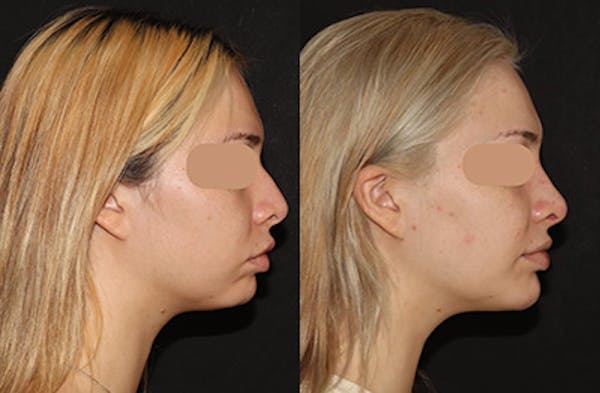 Chin Augmentation Before & After Gallery - Patient 268360 - Image 4