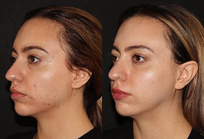 Chemical Peel Before & After Gallery - Patient 320160 - Image 2