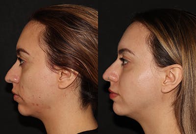 Chemical Peel Before & After Gallery - Patient 320160 - Image 1