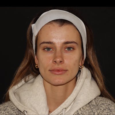 Chemical Peel Before & After Gallery - Patient 110581 - Image 4