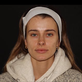 Chemical Peel Before & After Gallery - Patient 110581 - Image 4