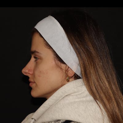 Chemical Peel Before & After Gallery - Patient 110581 - Image 2