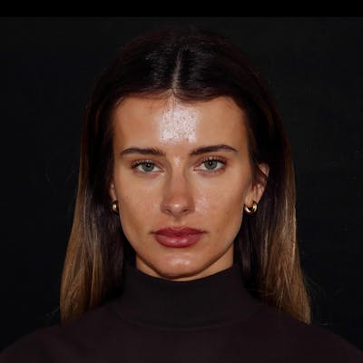 Chemical Peel Before & After Gallery - Patient 110581 - Image 3
