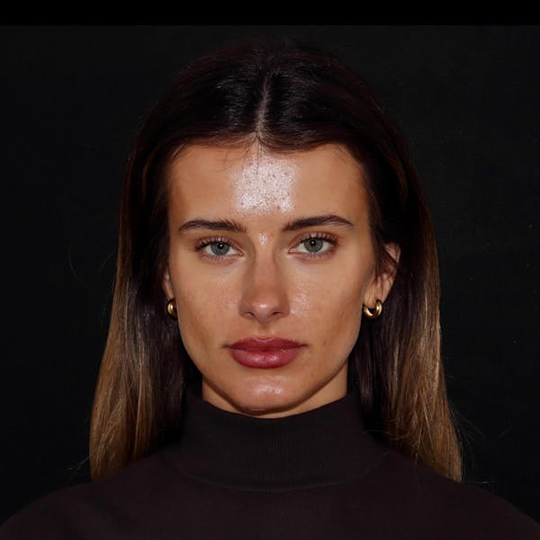Chemical Peel Before & After Gallery - Patient 110581 - Image 3