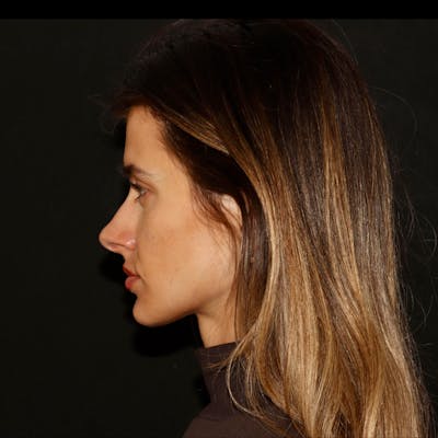 Chemical Peel Before & After Gallery - Patient 110581 - Image 1