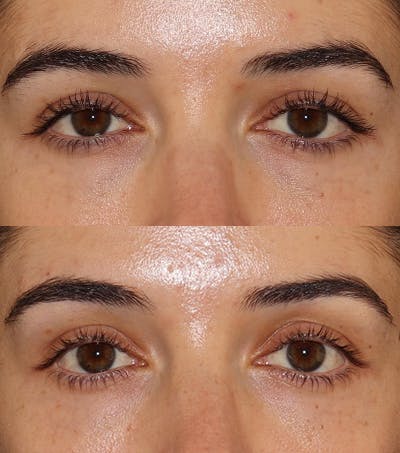 Under Eye Filler Before & After Gallery - Patient 371627 - Image 1