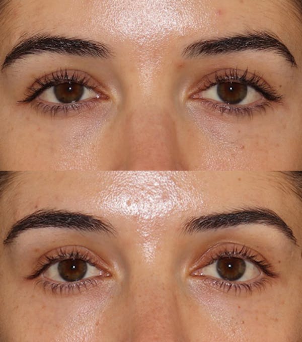 Under Eye Filler Before & After Gallery - Patient 371627 - Image 1