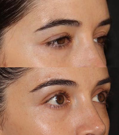 Under Eye Filler Before & After Gallery - Patient 371627 - Image 2