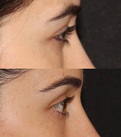 Eye Filler Before & After Gallery - Patient 371627 - Image 3