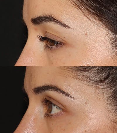 Under Eye Filler Before & After Gallery - Patient 371627 - Image 4