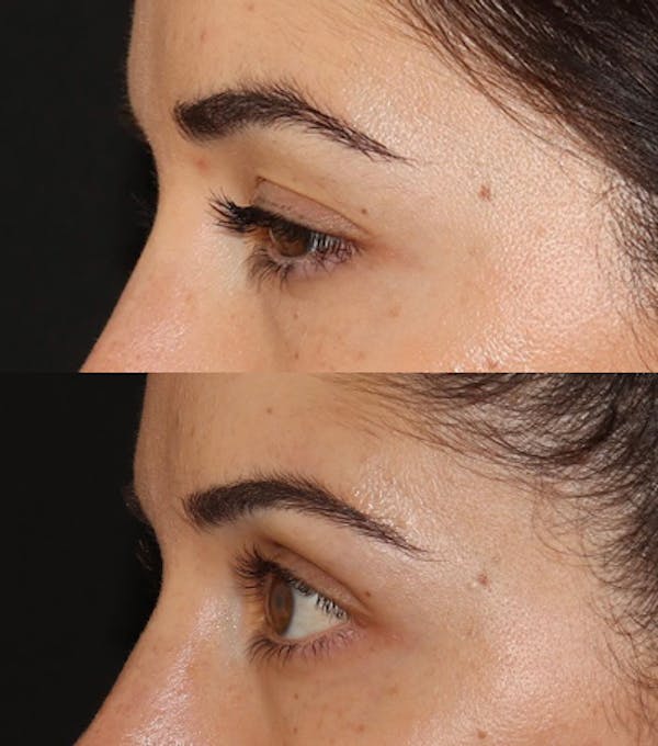 Under Eye Filler Before & After Gallery - Patient 371627 - Image 4
