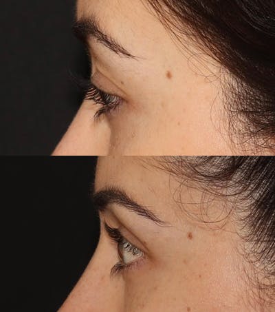 Eye Filler Before & After Gallery - Patient 371627 - Image 5