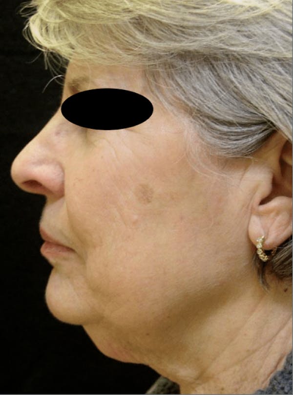 Before & After Facelift in NYC