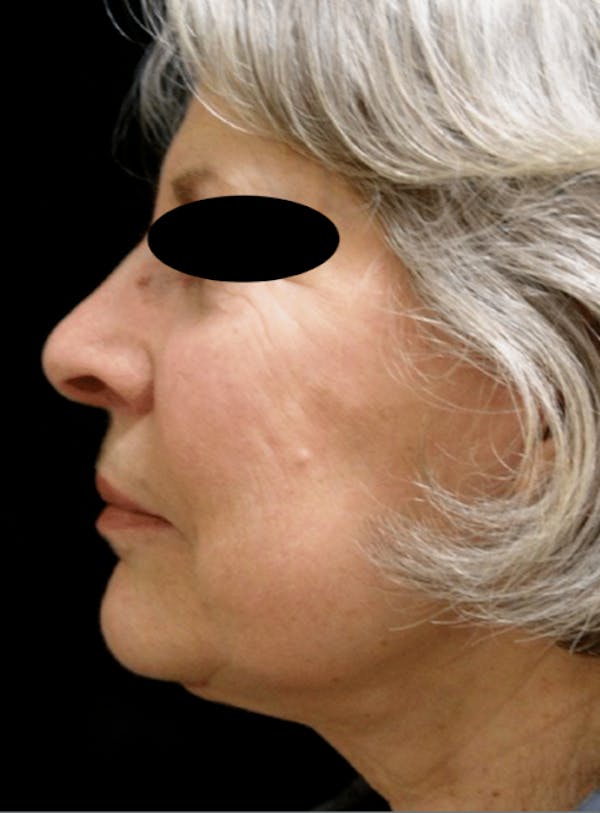 Before & After Facelift in NYC