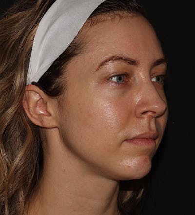 Chin Filler Before & After Gallery - Patient 100632 - Image 1