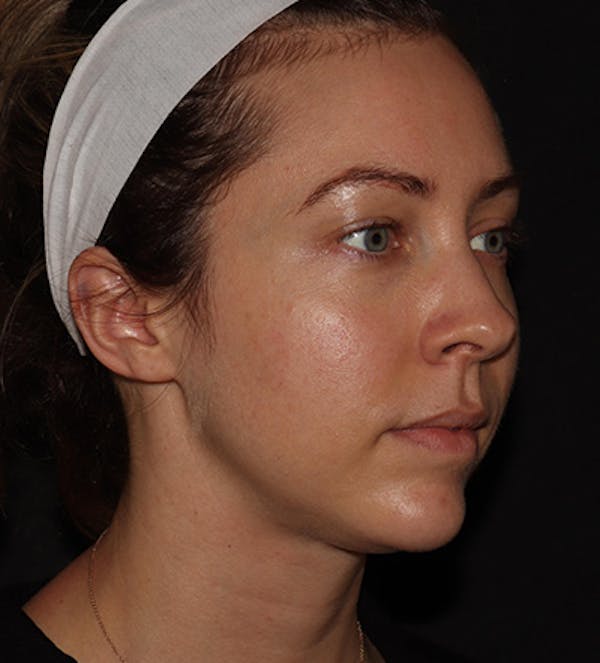 Chin Filler Before & After Gallery - Patient 100632 - Image 2