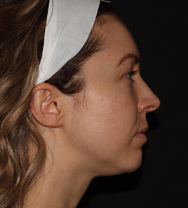 Chin Filler Before & After Gallery - Patient 100632 - Image 3