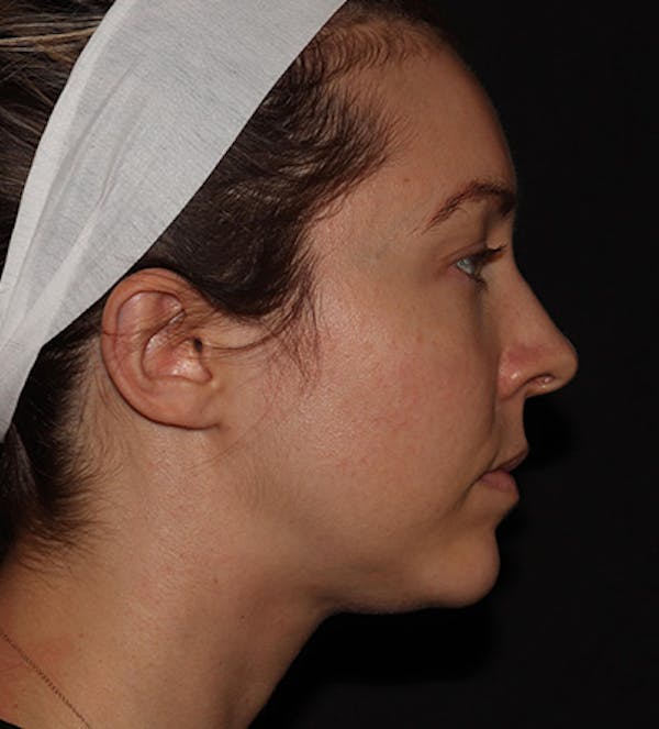 Chin Filler Before & After Gallery - Patient 100632 - Image 4