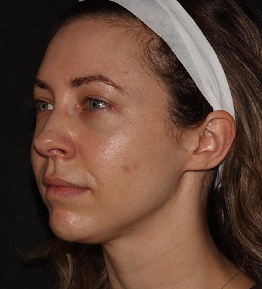 Chin Filler Before & After Gallery - Patient 100632 - Image 5