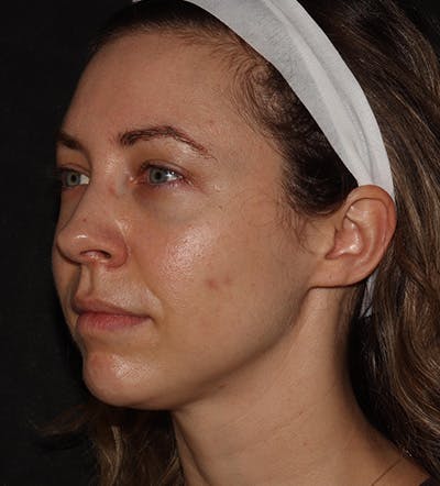 Chin Filler Before & After Gallery - Patient 100632 - Image 5