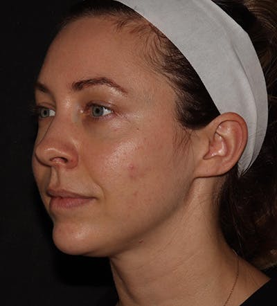 Chin Filler Before & After Gallery - Patient 100632 - Image 6