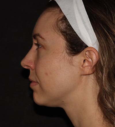 Chin Filler Before & After Gallery - Patient 100632 - Image 7