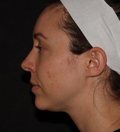 Chin Filler Before & After Gallery - Patient 100632 - Image 8