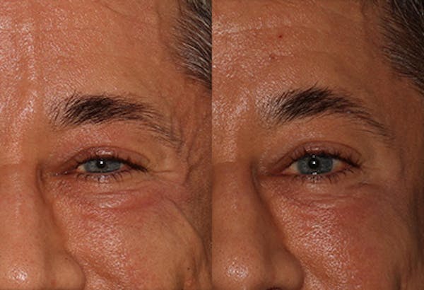 Exion Before & After Gallery - Patient 217812 - Image 1