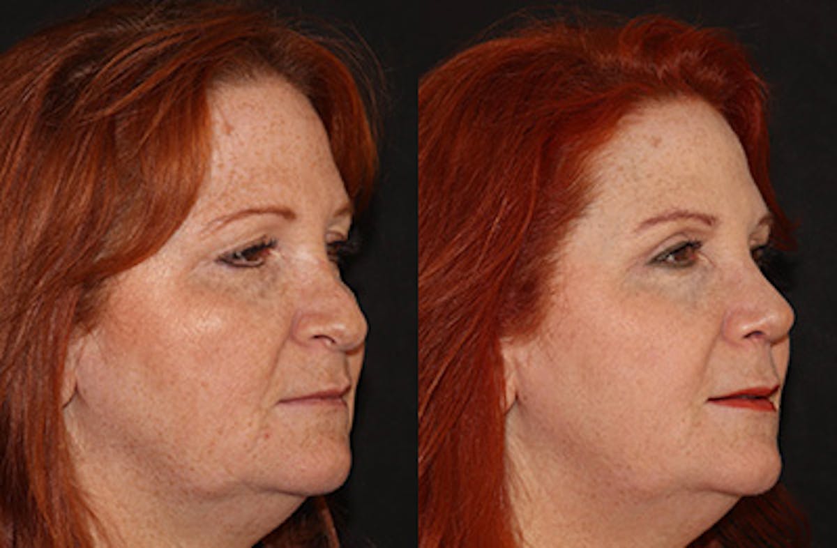 Rhinoplasty Before & After Gallery - Patient 251389 - Image 2