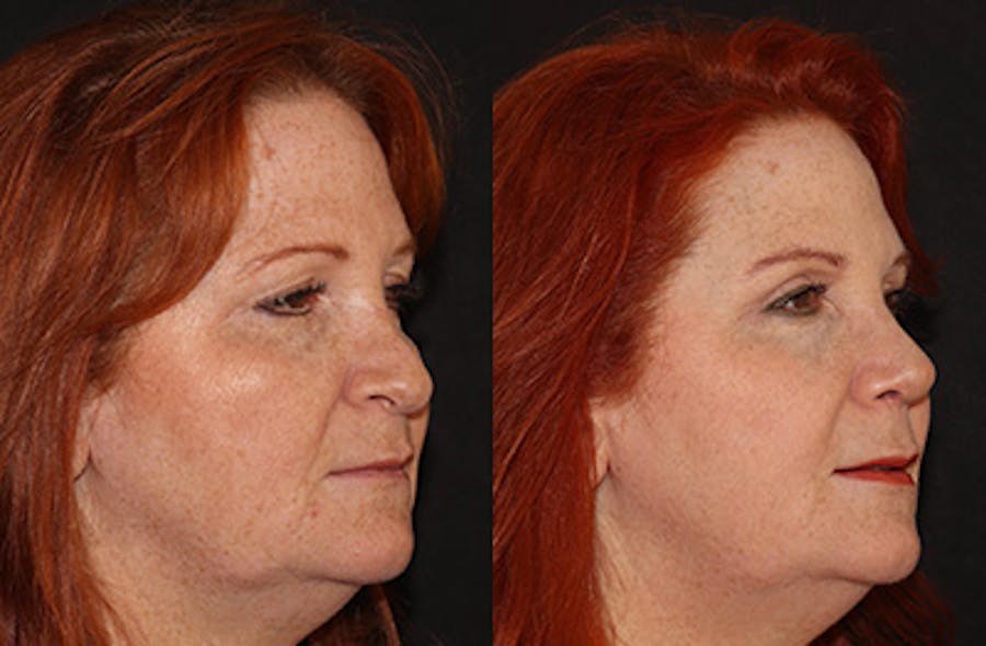 Rhinoplasty Before & After Gallery - Patient 251389 - Image 2