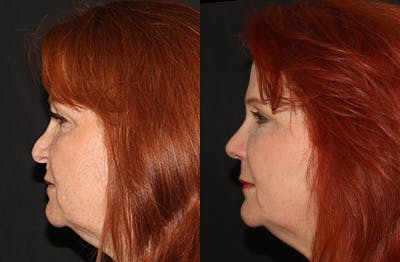 Rhinoplasty Before & After Gallery - Patient 251389 - Image 1