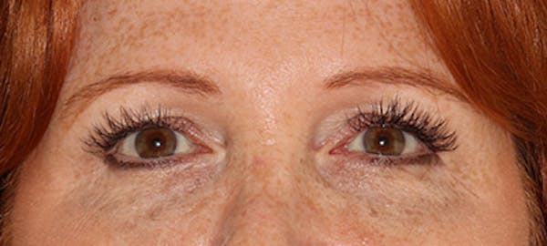  Blepharoplasty Before & After Gallery - Patient 167946 - Image 1