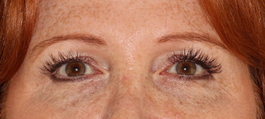  Blepharoplasty Before & After Gallery - Patient 167946 - Image 1