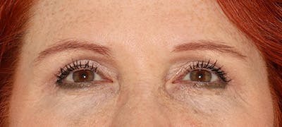  Blepharoplasty Before & After Gallery - Patient 167946 - Image 2