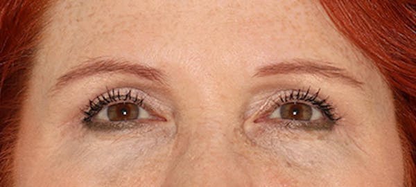  Blepharoplasty Before & After Gallery - Patient 167946 - Image 2