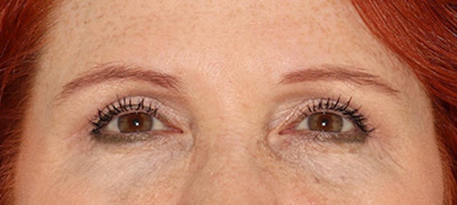 Blepharoplasty Before & After Gallery - Patient 167946 - Image 2