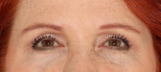 Blepharoplasty Before & After Gallery - Patient 167946 - Image 2