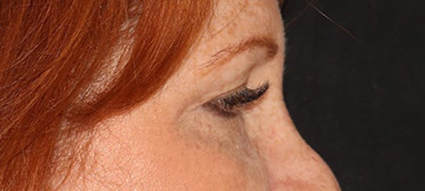 Blepharoplasty Before & After Gallery - Patient 167946 - Image 3