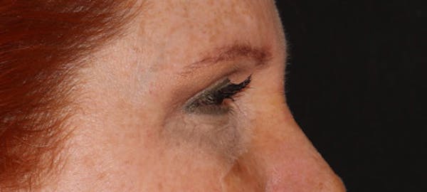  Blepharoplasty Before & After Gallery - Patient 167946 - Image 4