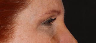 Blepharoplasty Before & After Gallery - Patient 167946 - Image 4