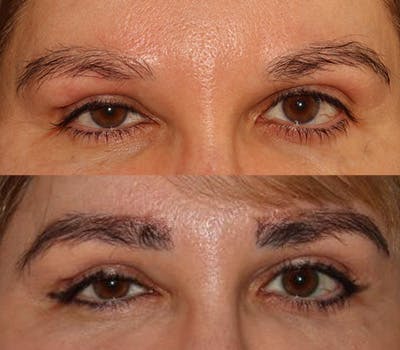 Eyebrow Transplant Before & After Gallery - Patient 105796 - Image 1