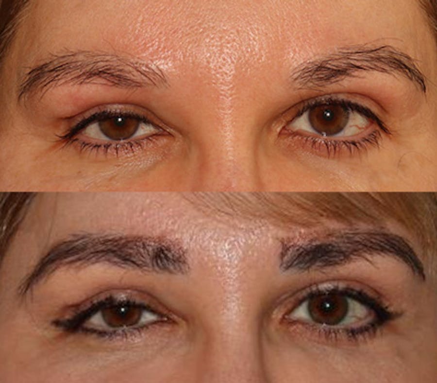 Eyebrow Transplant Before & After Gallery - Patient 105796 - Image 1