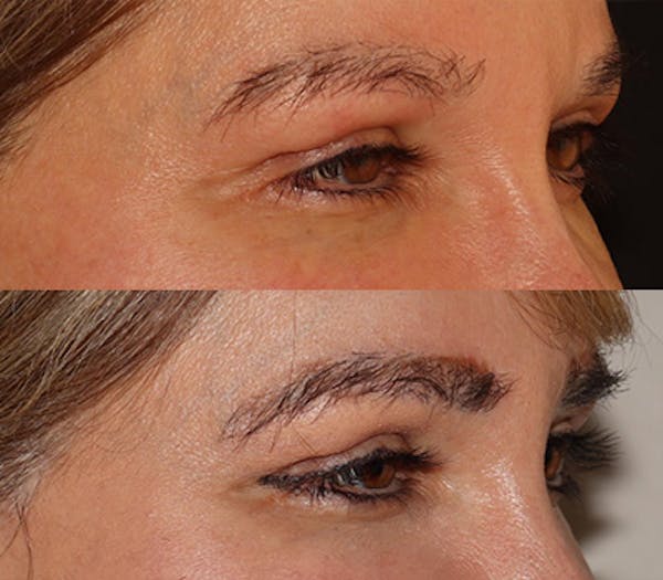 Eyebrow Transplant Before & After Gallery - Patient 105796 - Image 2