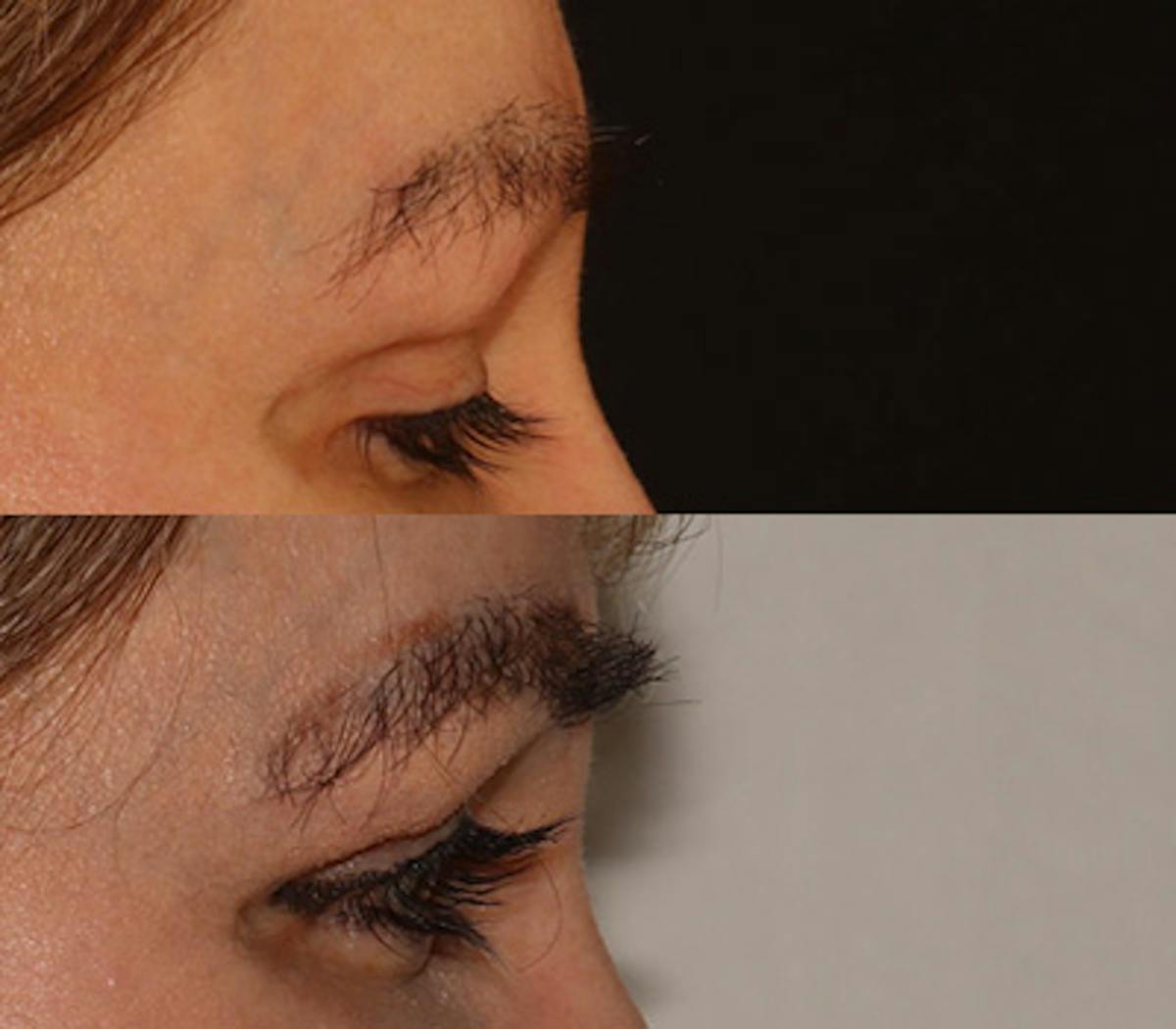 Eyebrow Transplant Before & After Gallery - Patient 105796 - Image 3