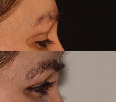Eyebrow Transplant Before & After Gallery - Patient 105796 - Image 3