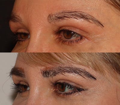 Eyebrow Transplant Before & After Gallery - Patient 105796 - Image 4
