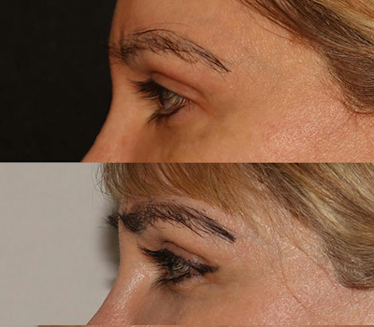 Eyebrow Transplant Before & After Gallery - Patient 105796 - Image 5