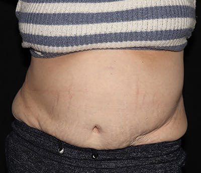 Vanquish Before & After Gallery - Patient 697781 - Image 1
