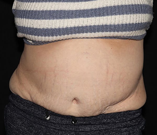 Vanquish Before & After Gallery - Patient 697781 - Image 1